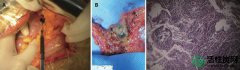 【研究】结肠直肠癌淋巴结染色通过活性炭纳米颗粒悬浮体内或亚甲蓝体外